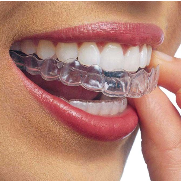 mascherine-trasparenti-allineamento-dentale