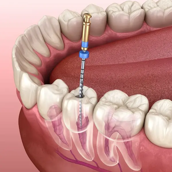 servizio_Endodonzia
