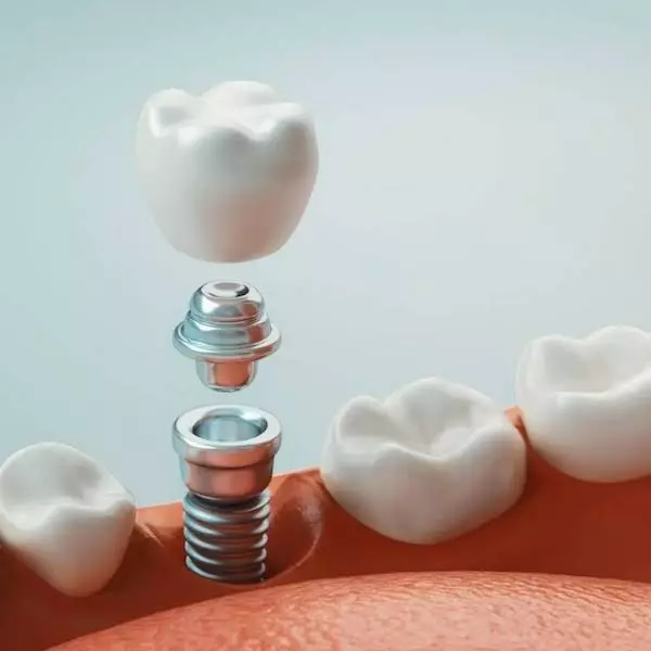 servizio_Implantologia