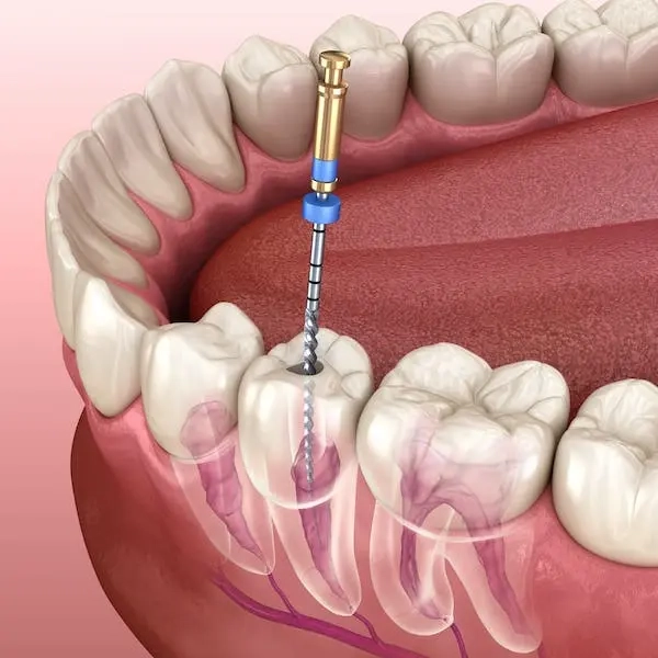 endodonzia