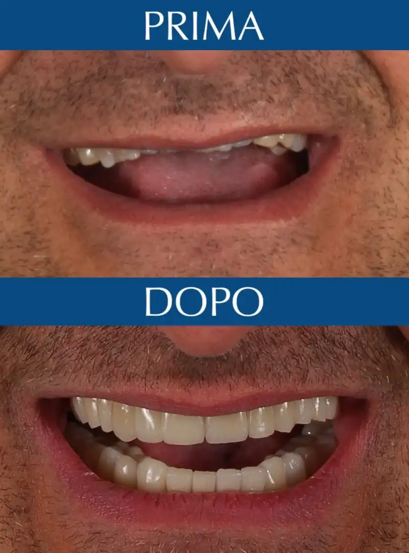Prima e Dopo