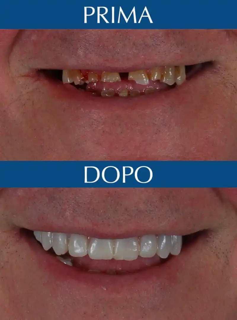 Prima e Dopo