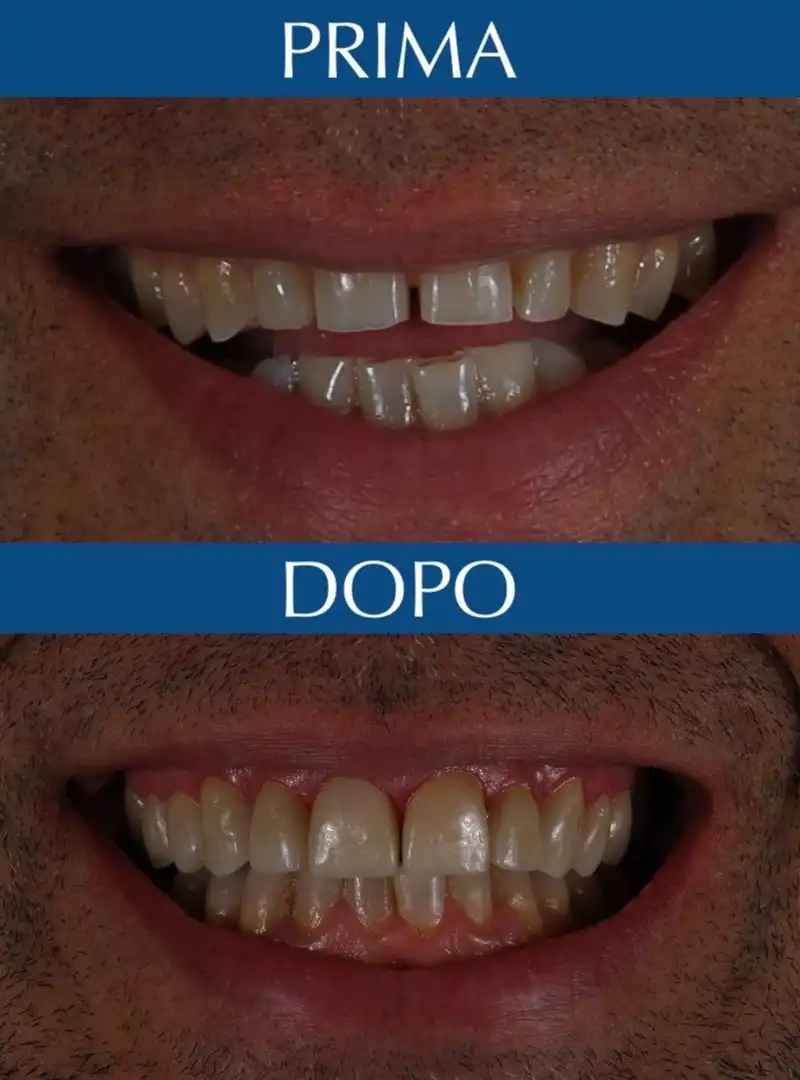 Prima e Dopo