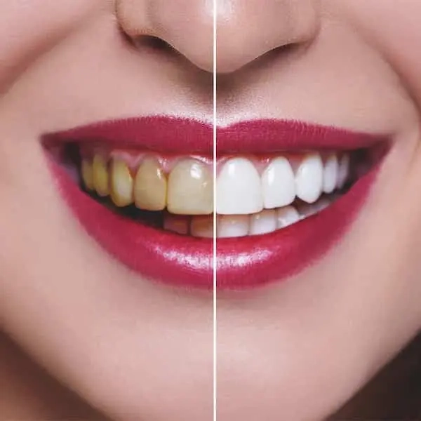 faccette-estetiche